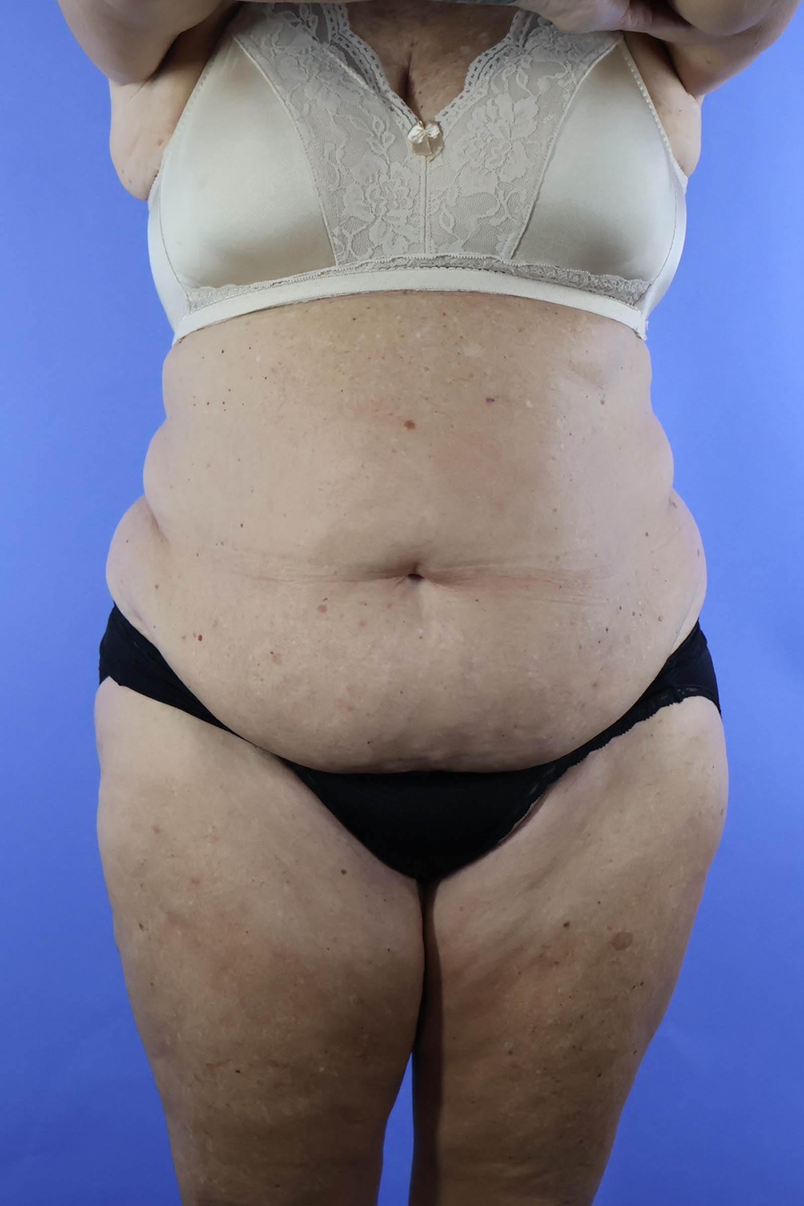 Tummy Tuck real patient case photo