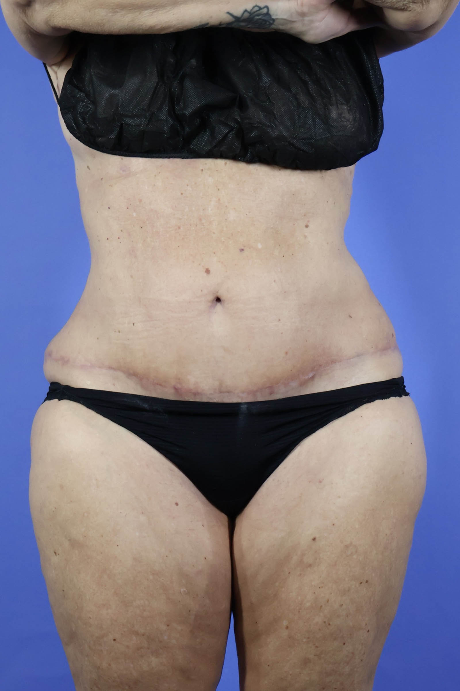 Tummy Tuck real patient case photo
