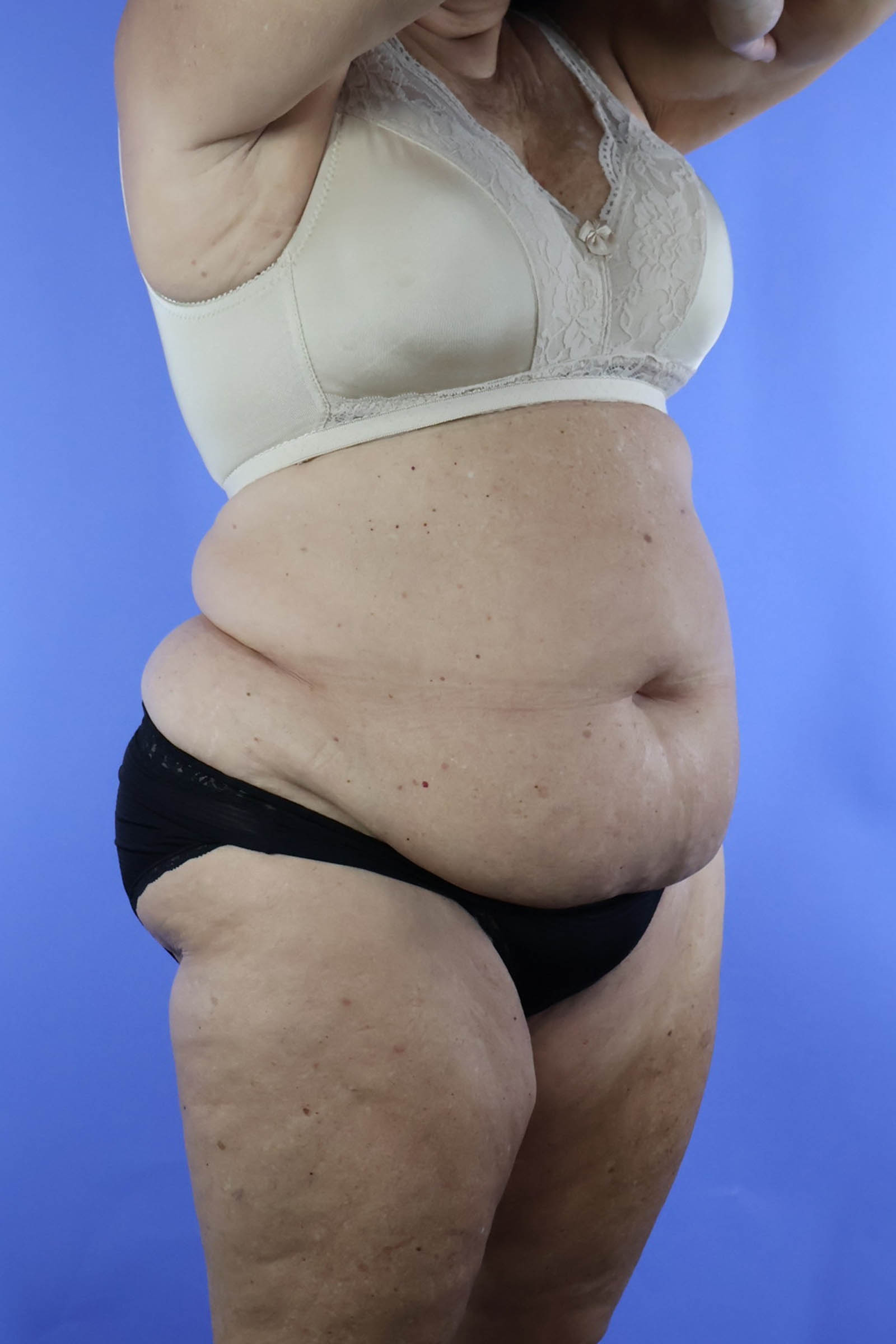 Tummy Tuck real patient case photo