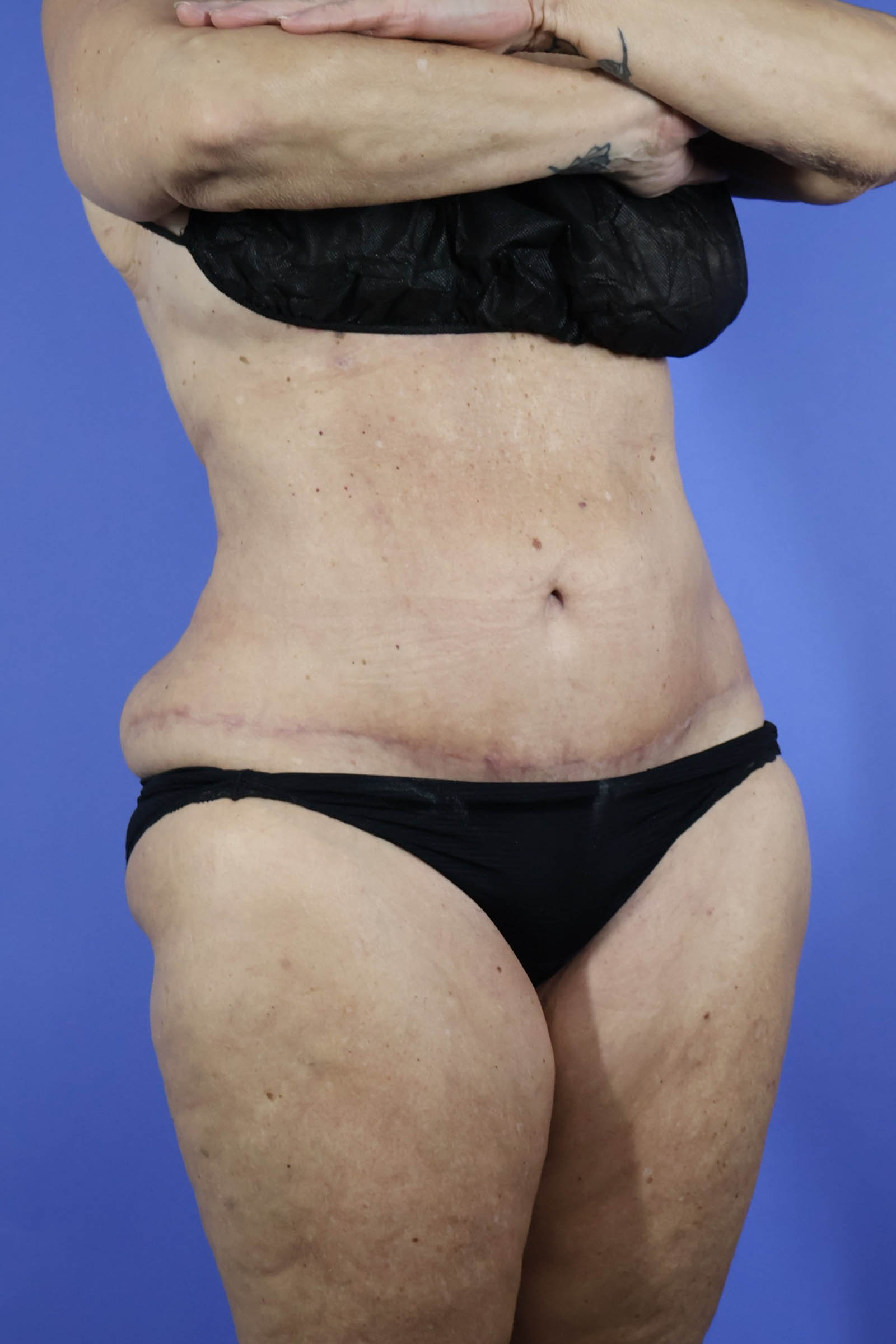 Tummy Tuck real patient case photo