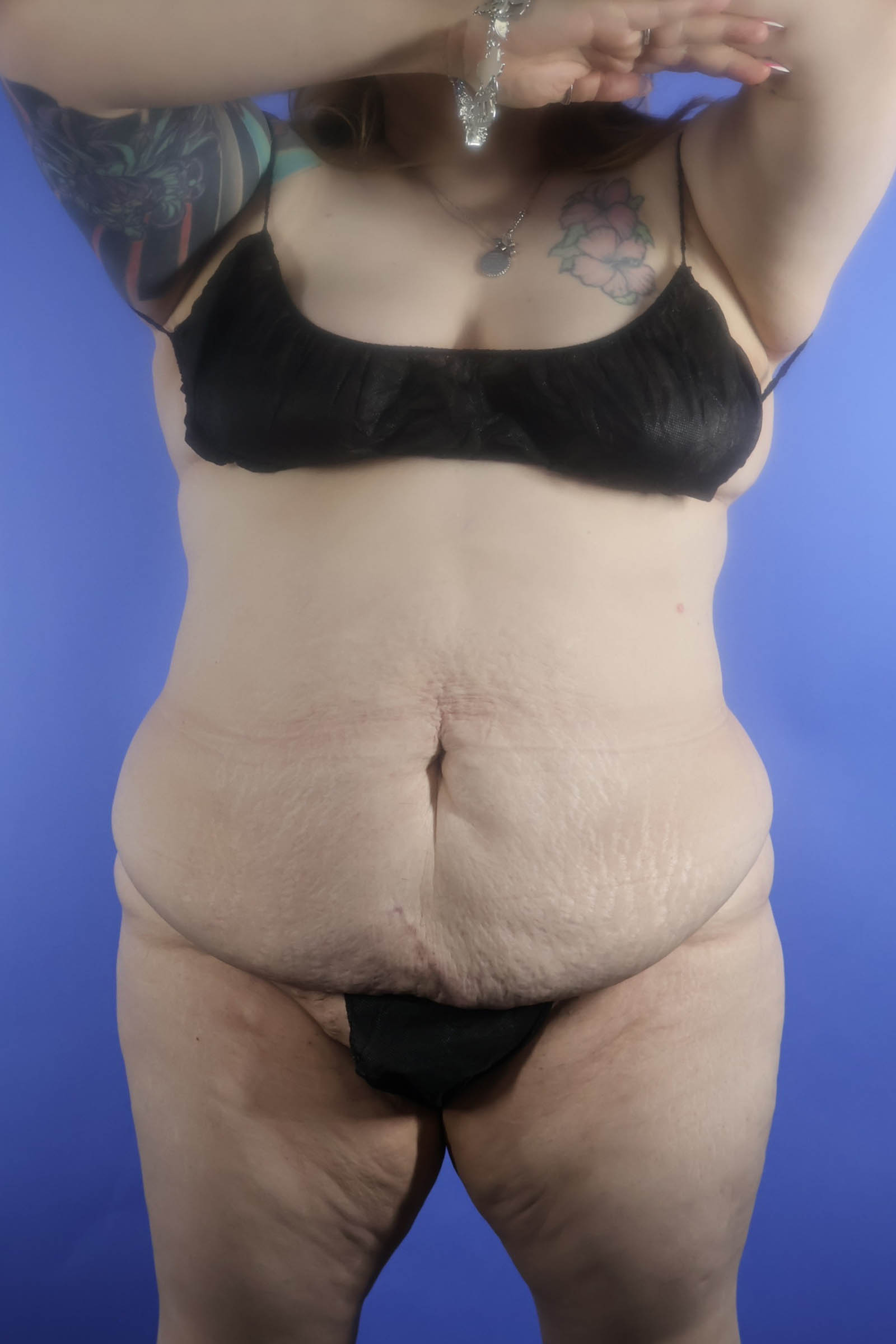 Tummy Tuck real patient case photo