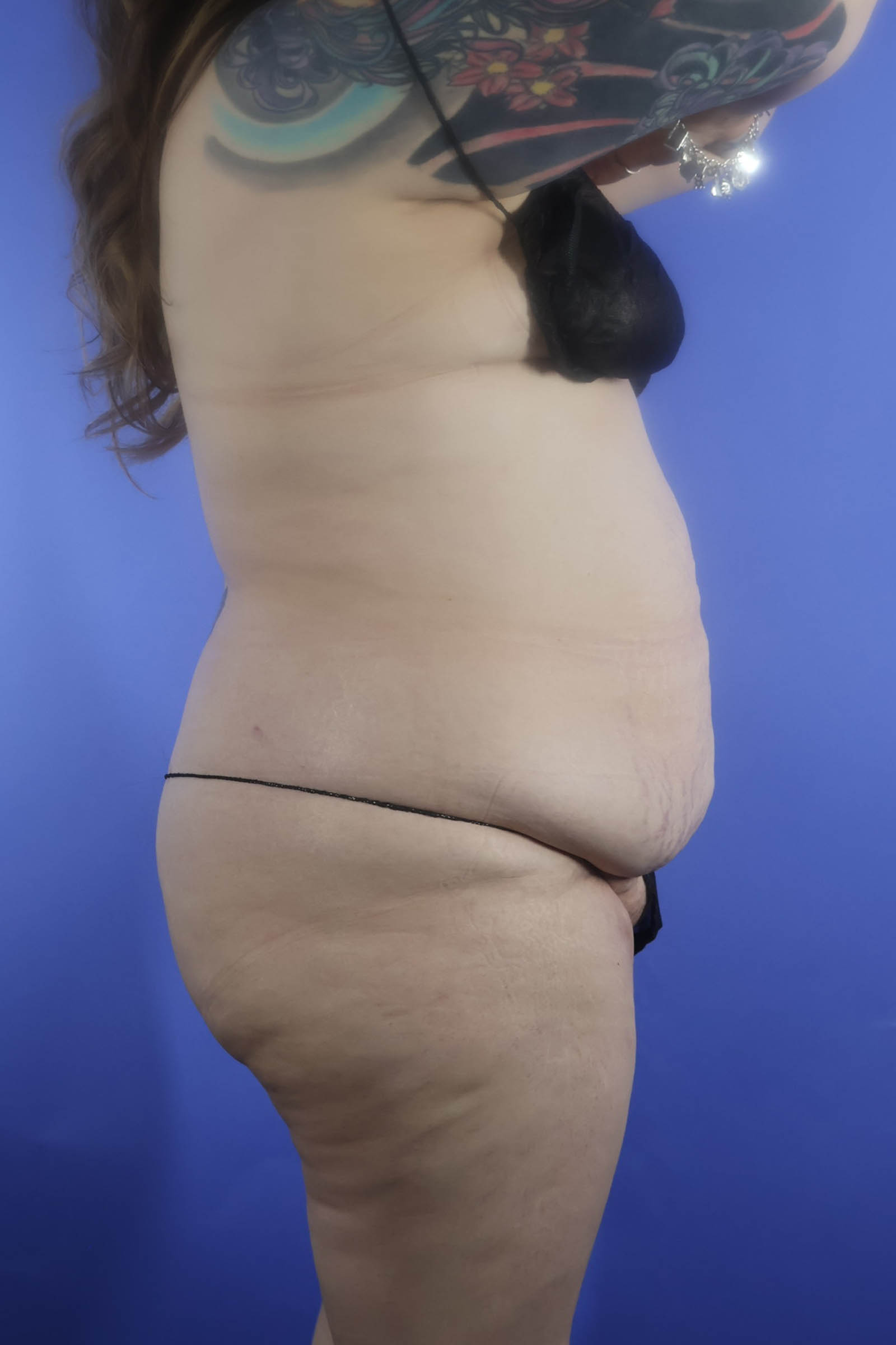 Tummy Tuck real patient case photo