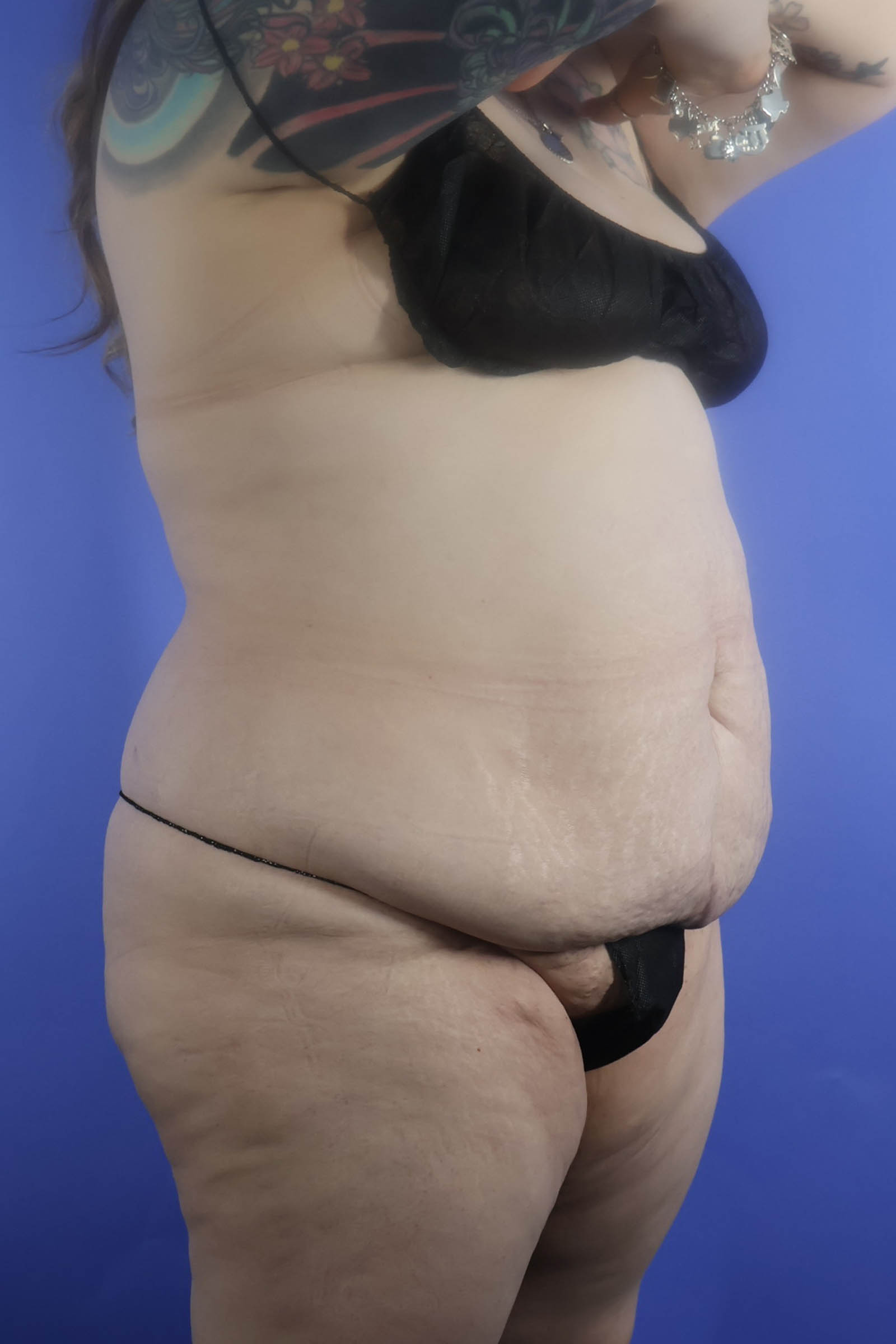 Tummy Tuck real patient case photo