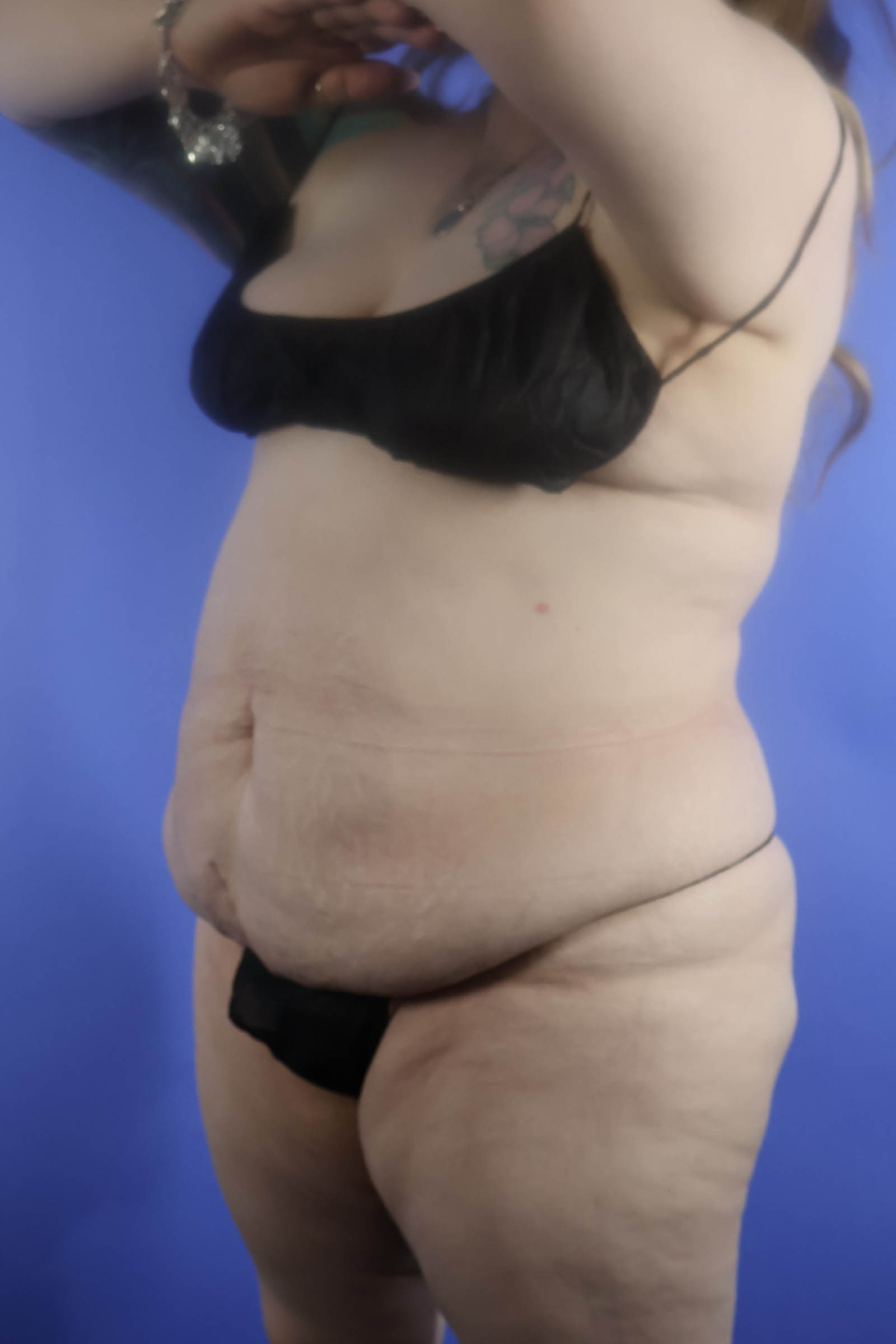 Tummy Tuck real patient case photo