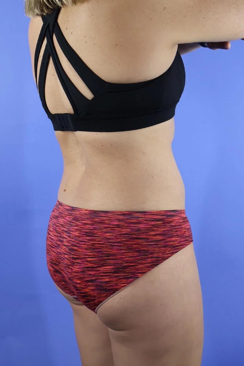 Tummy Tuck real patient case photo