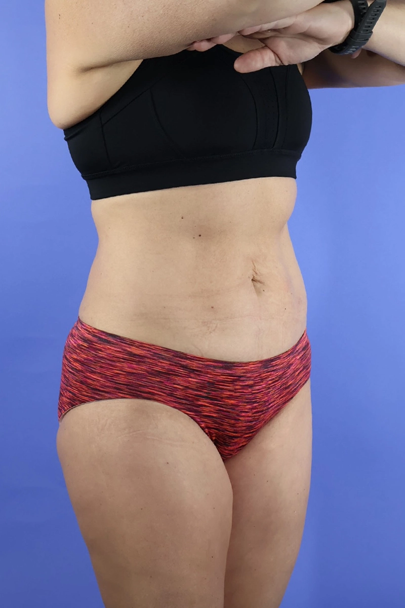 Tummy Tuck real patient case photo