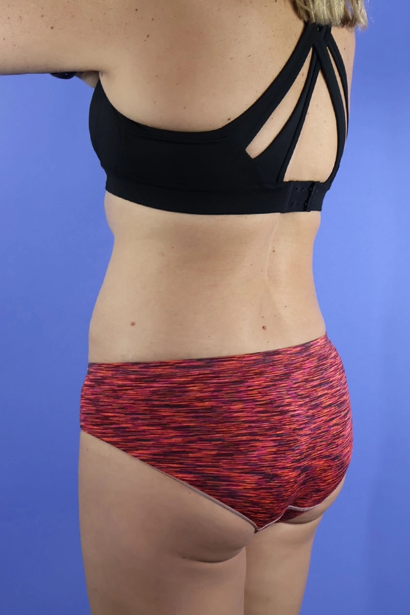 Tummy Tuck real patient case photo