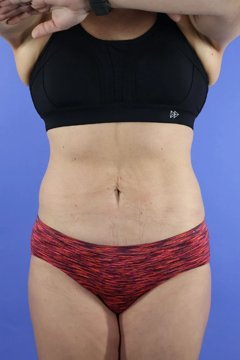 Tummy Tuck real patient case photo