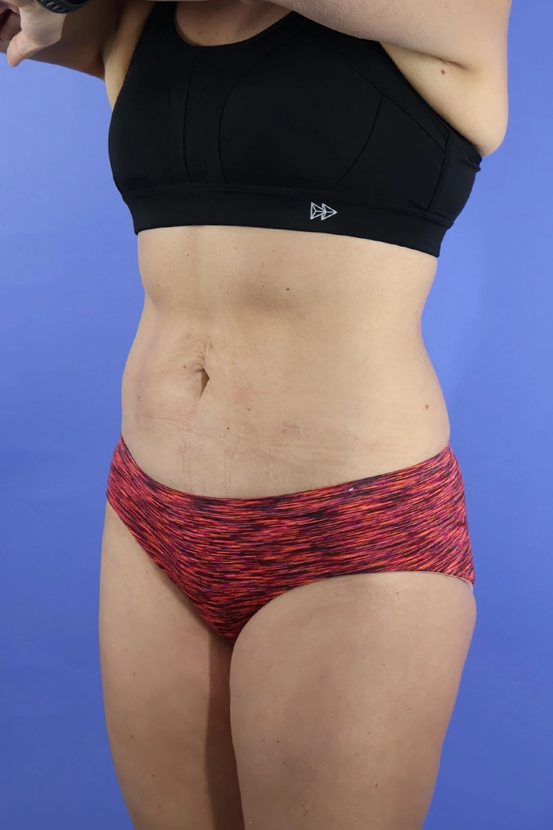 Tummy Tuck real patient case photo