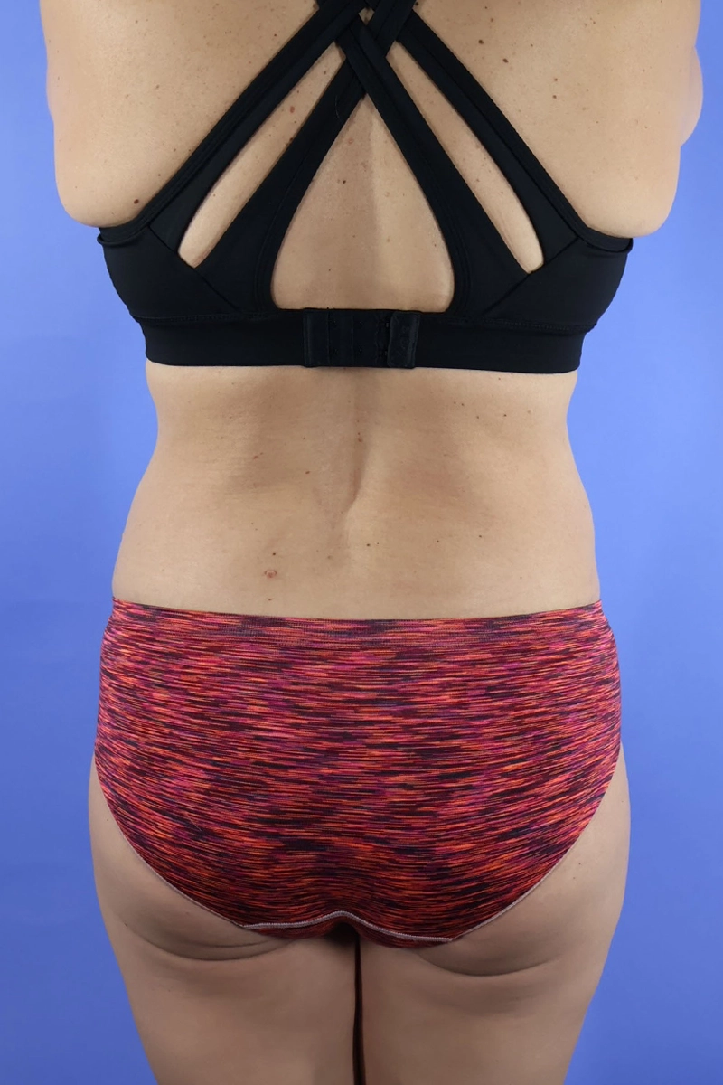 Tummy Tuck real patient case photo
