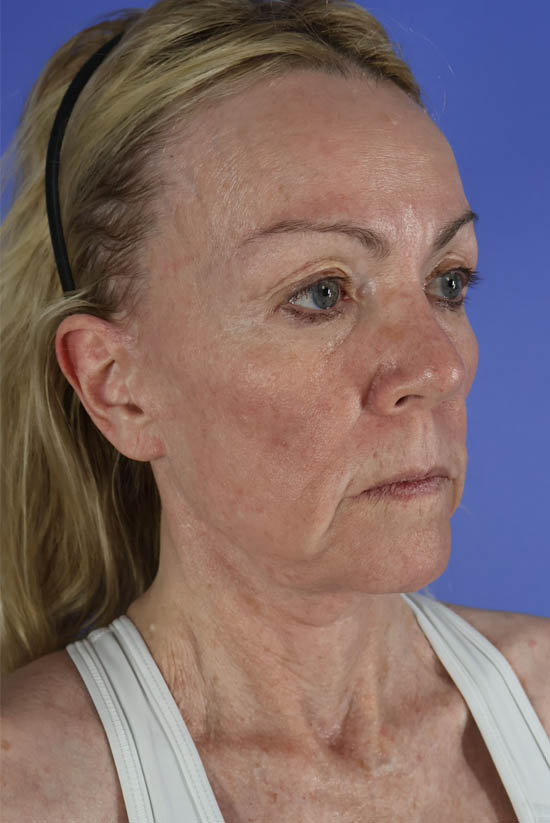 Facelift and Neck Lift real patient case photo
