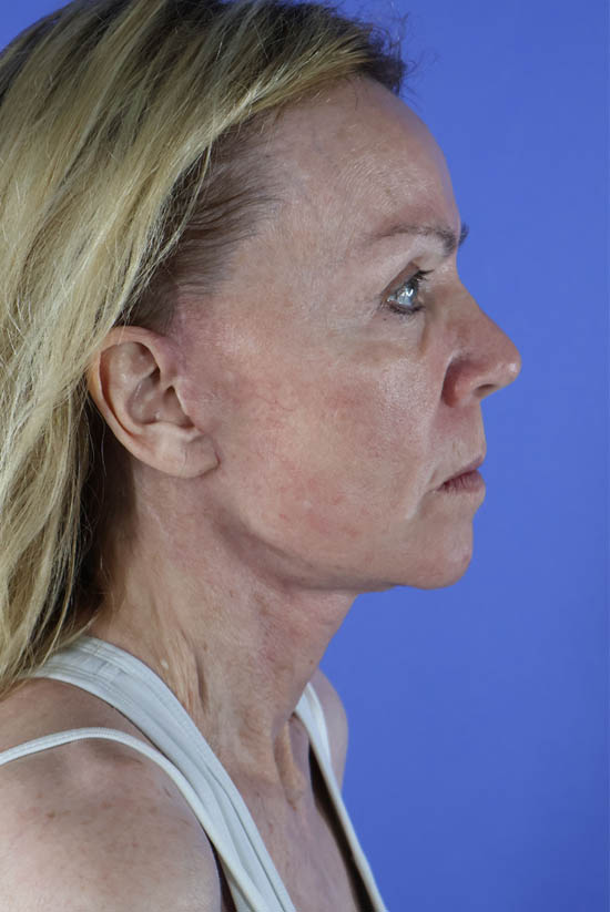 Facelift and Neck Lift real patient case photo