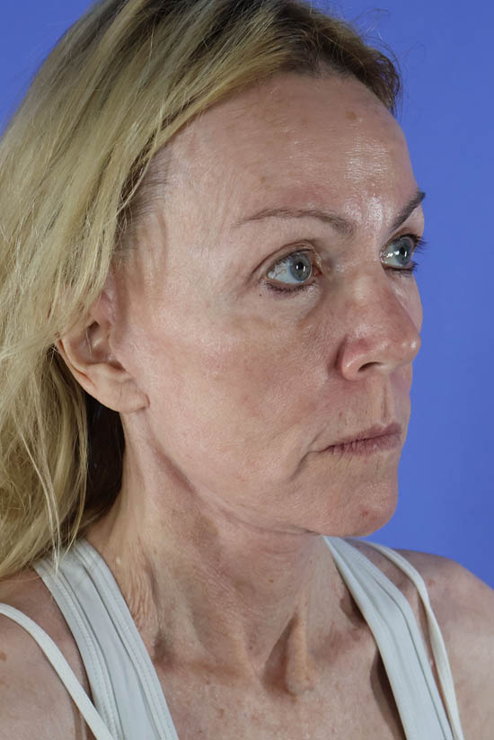 Facelift and Neck Lift real patient case photo