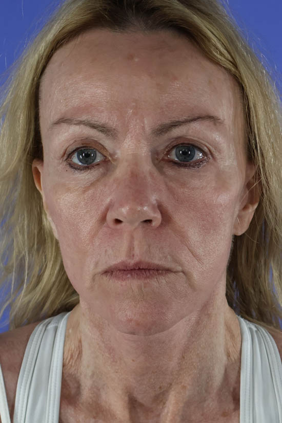 Facelift and Neck Lift real patient case photo