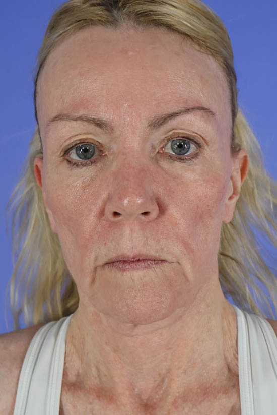 Facelift and Neck Lift real patient case photo