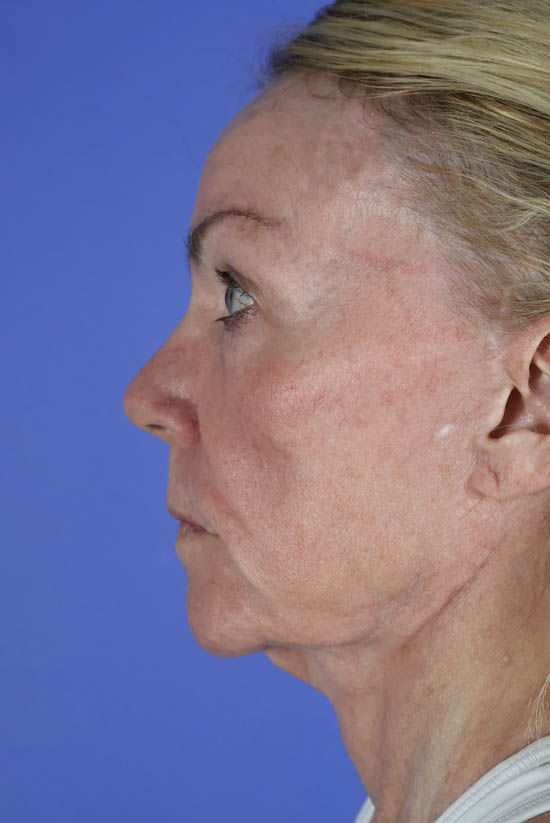 Facelift and Neck Lift real patient case photo