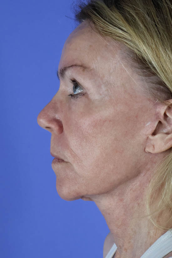 Facelift and Neck Lift real patient case photo