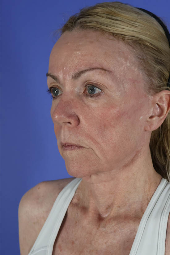 Facelift and Neck Lift real patient case photo