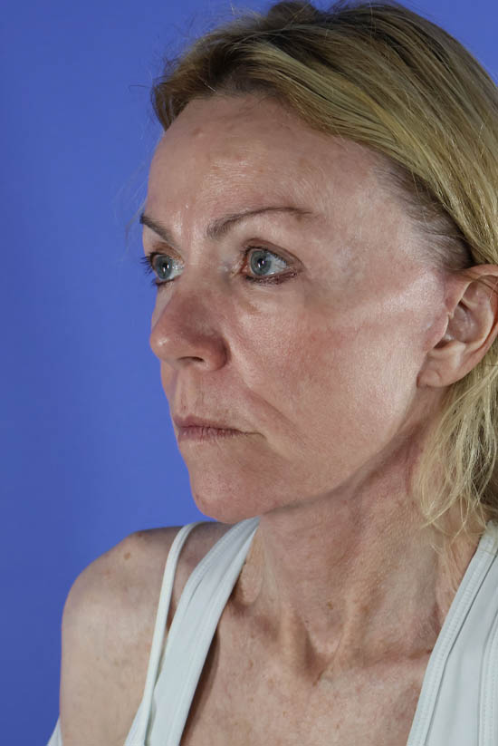 Facelift and Neck Lift real patient case photo
