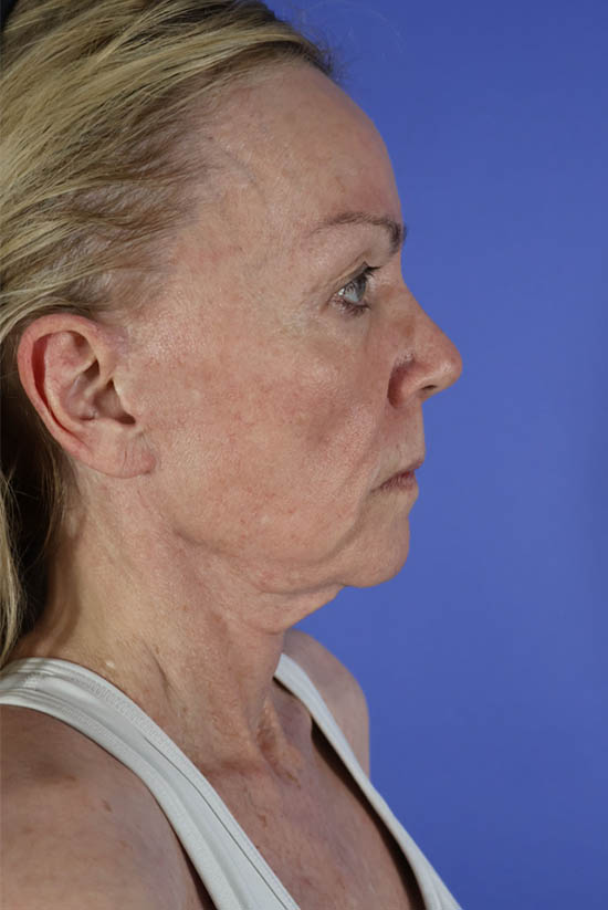 Facelift and Neck Lift real patient case photo