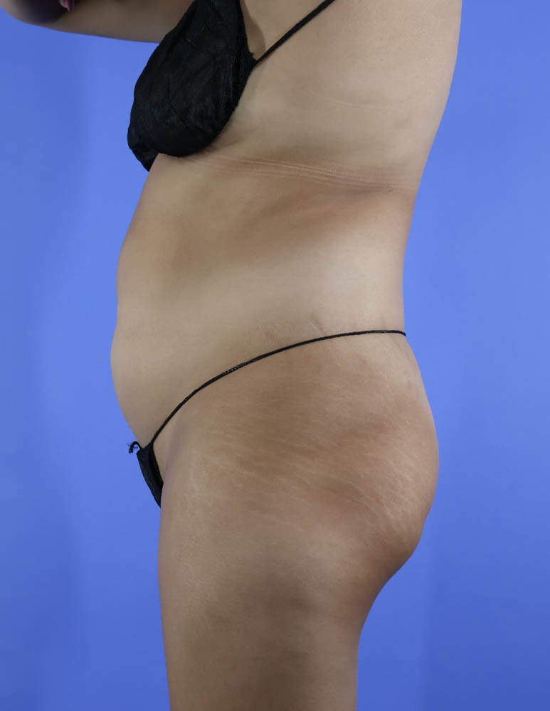 Brazilian Butt Lift real patient case photo