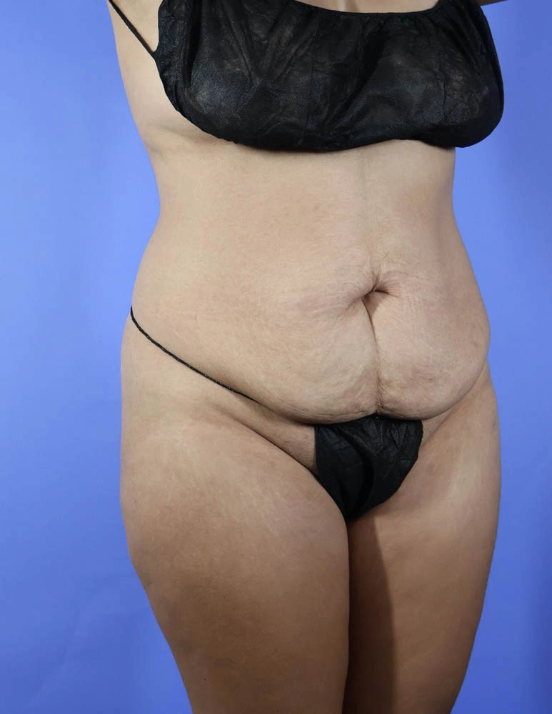 Brazilian Butt Lift real patient case photo