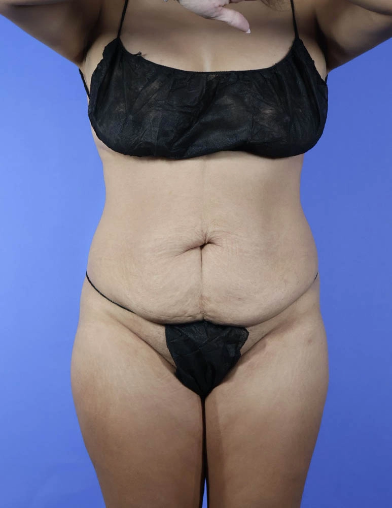 Brazilian Butt Lift real patient case photo