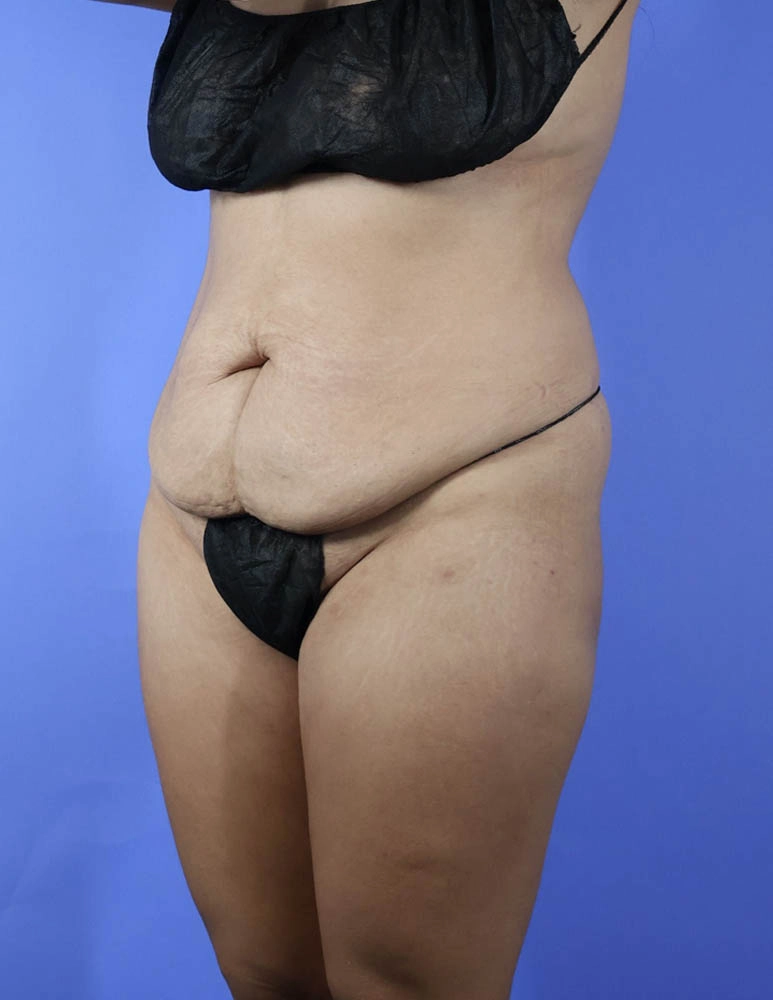Brazilian Butt Lift real patient case photo