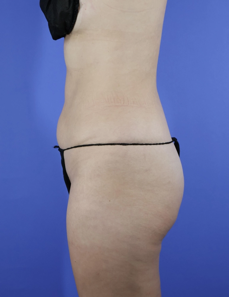 Brazilian Butt Lift real patient case photo
