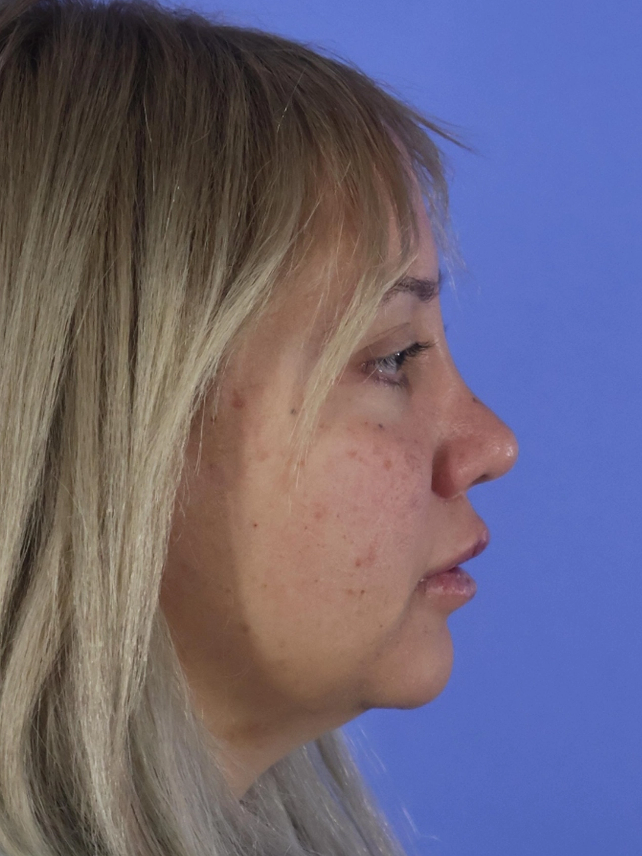 Rhinoplasty real patient case photo