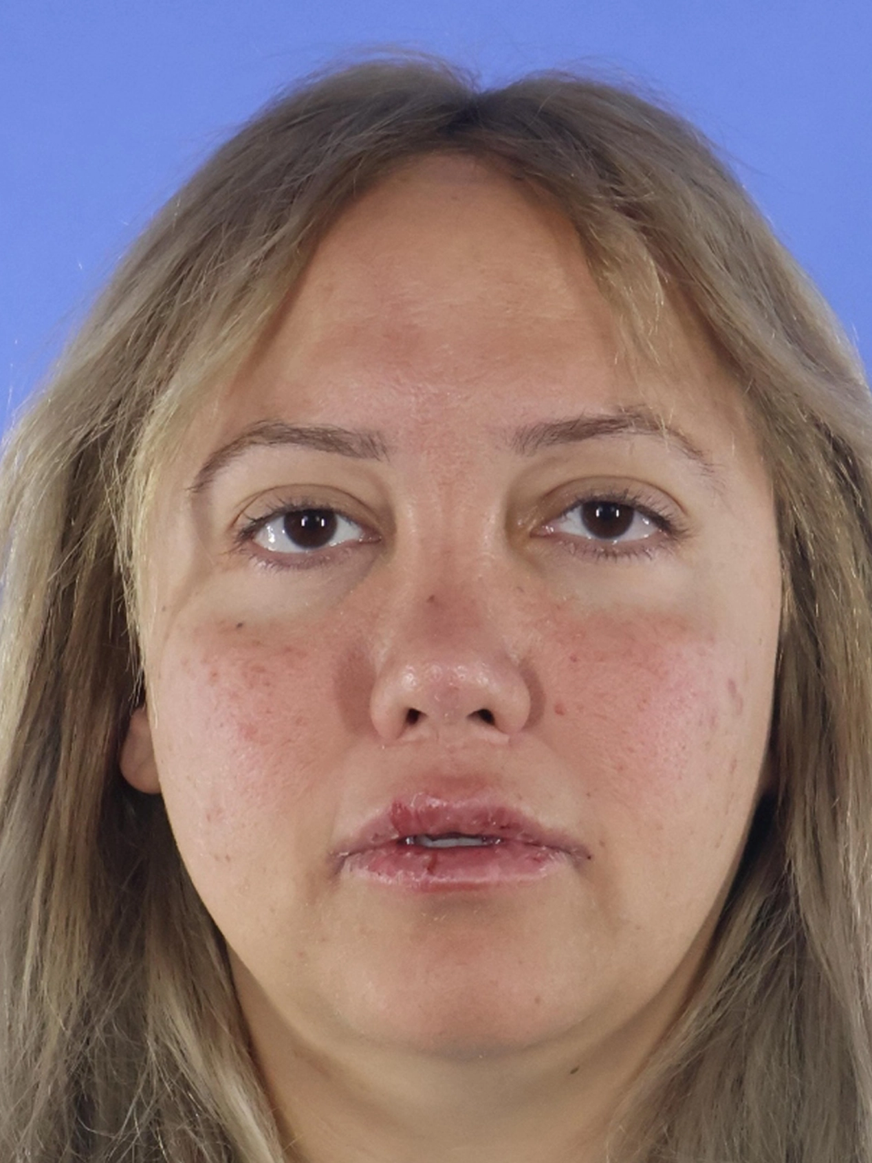 Rhinoplasty real patient case photo