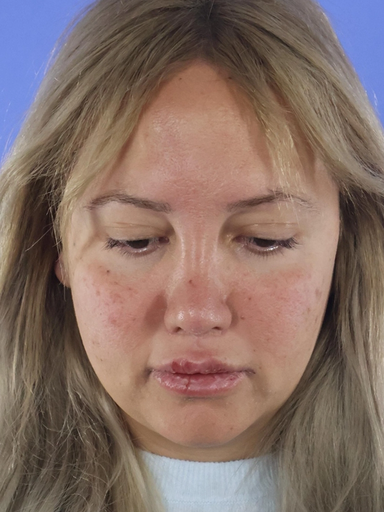 Rhinoplasty real patient case photo