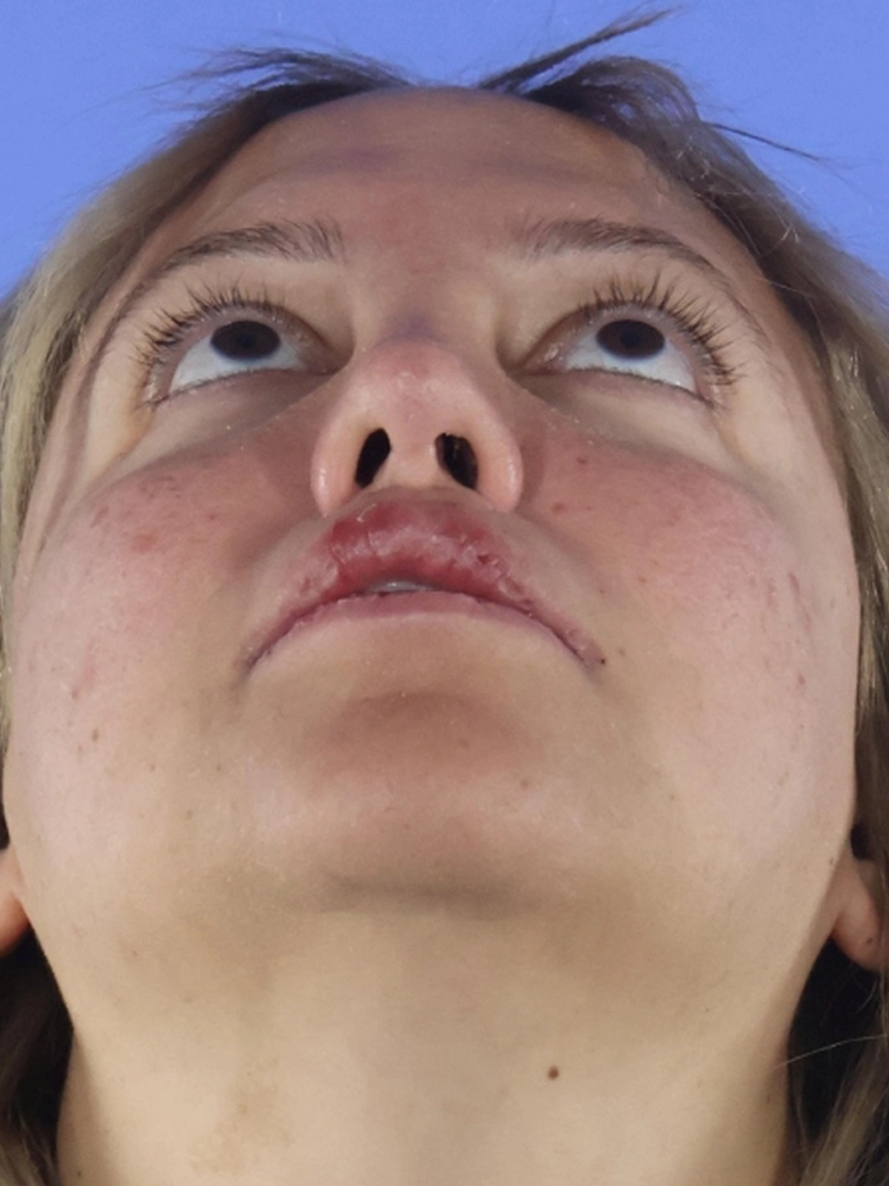 Rhinoplasty real patient case photo