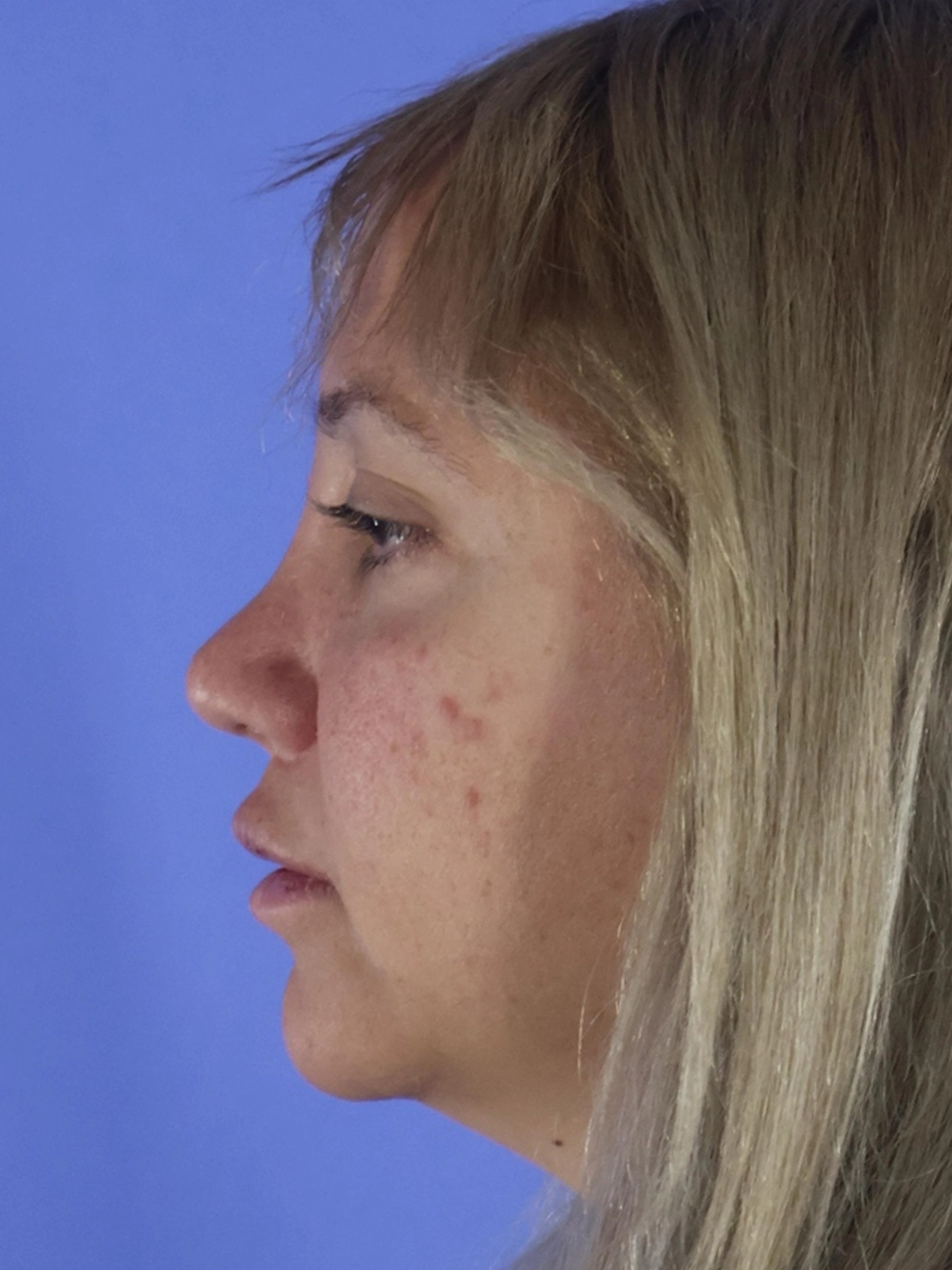 Rhinoplasty real patient case photo