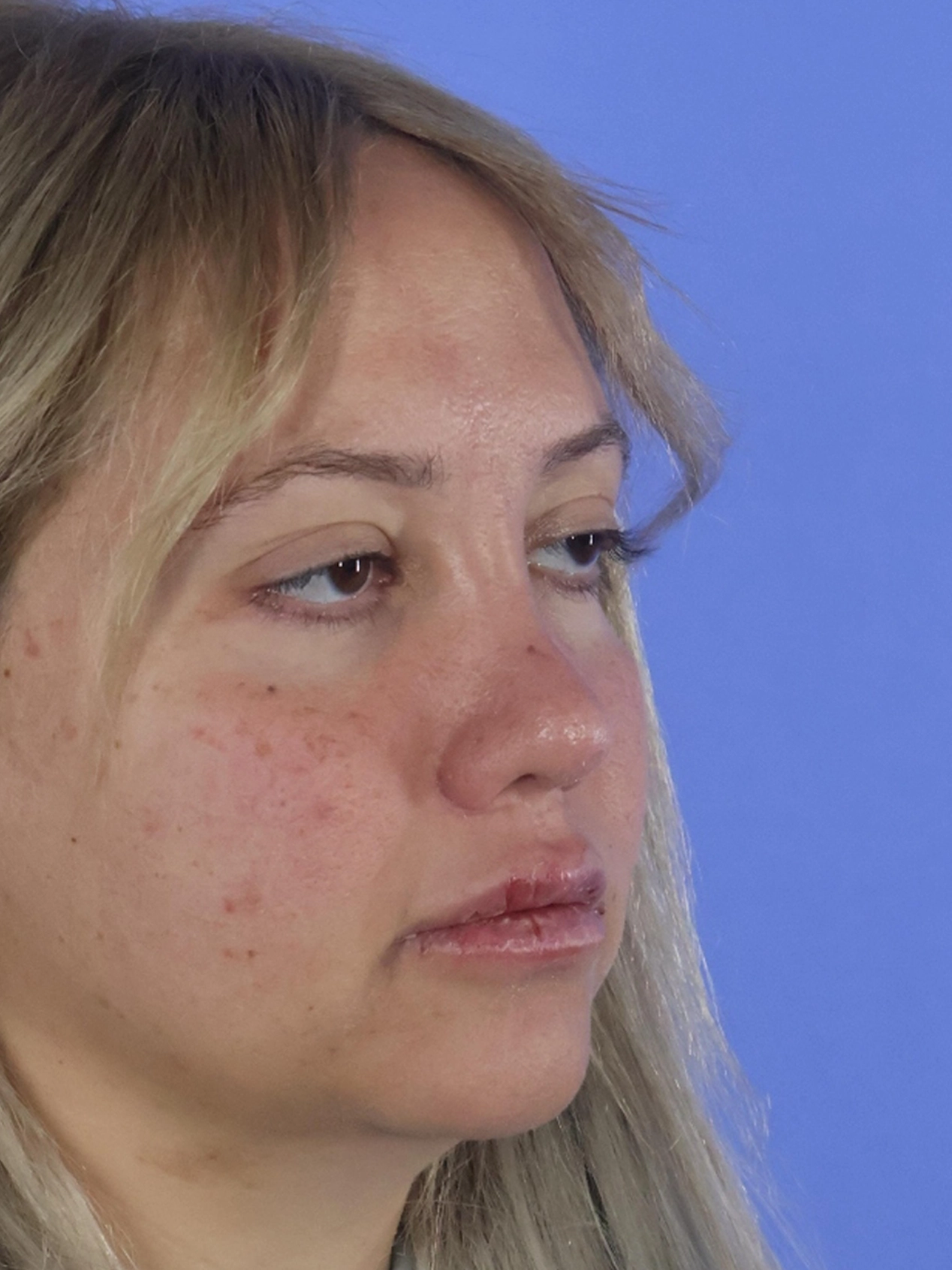 Rhinoplasty real patient case photo