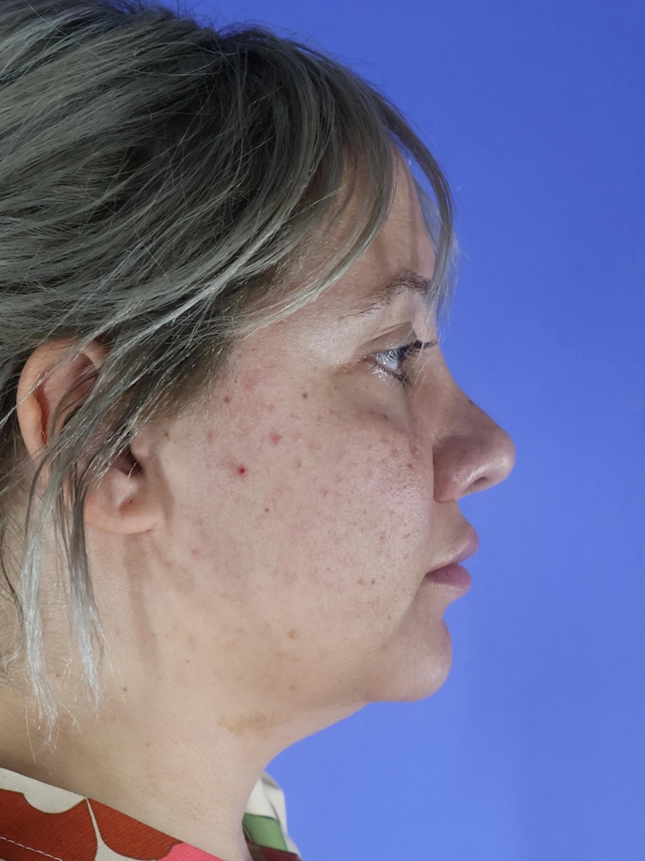 Rhinoplasty real patient case photo