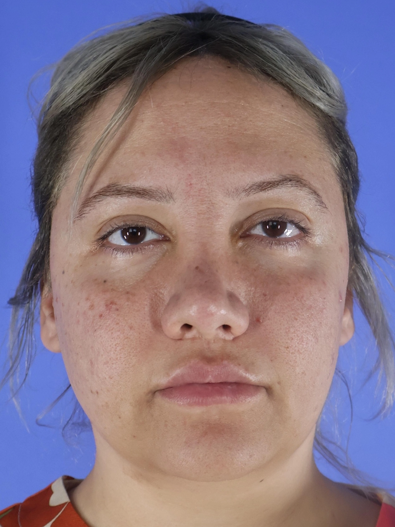 Rhinoplasty real patient case photo