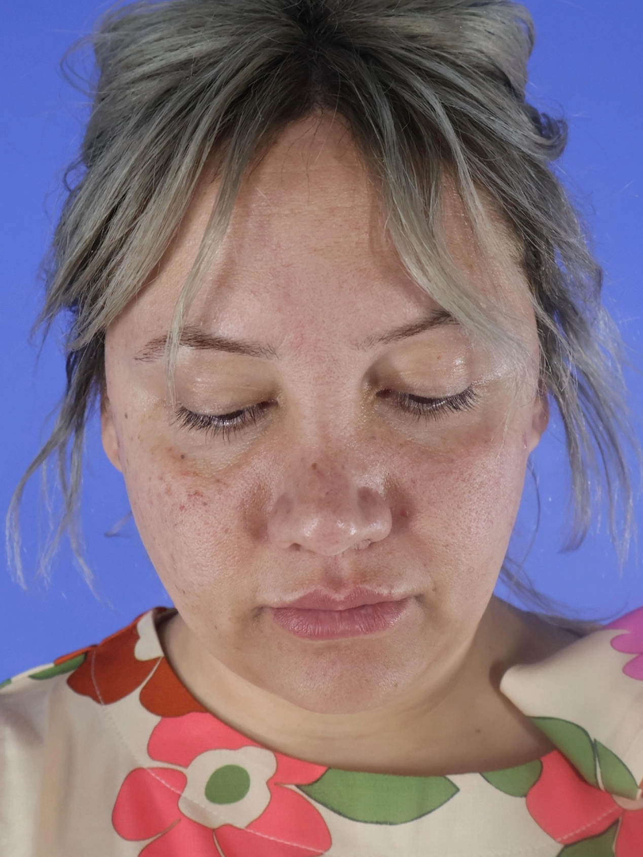 Rhinoplasty real patient case photo