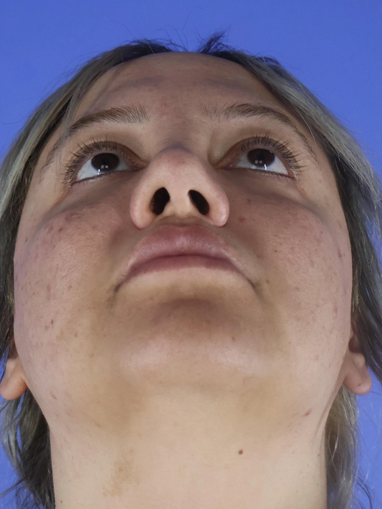 Rhinoplasty real patient case photo