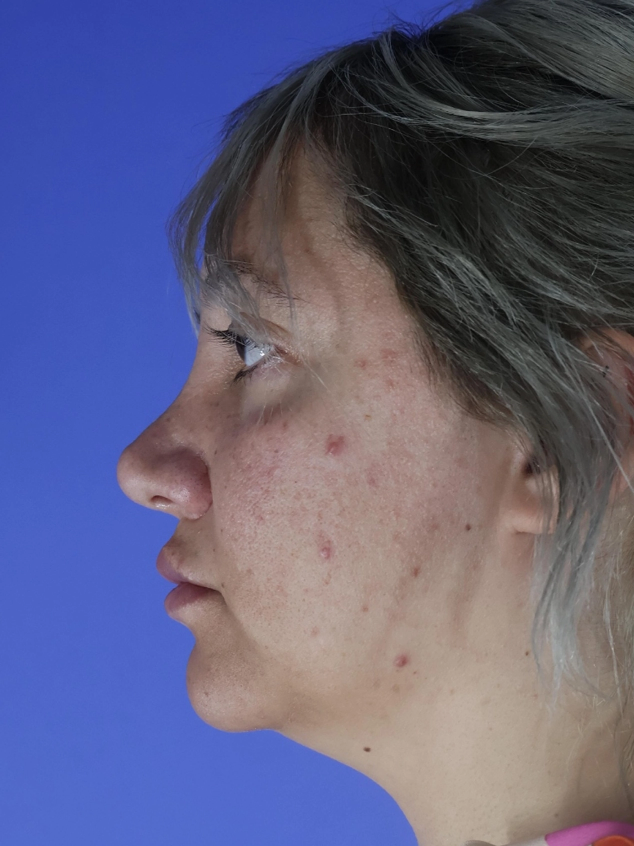 Rhinoplasty real patient case photo