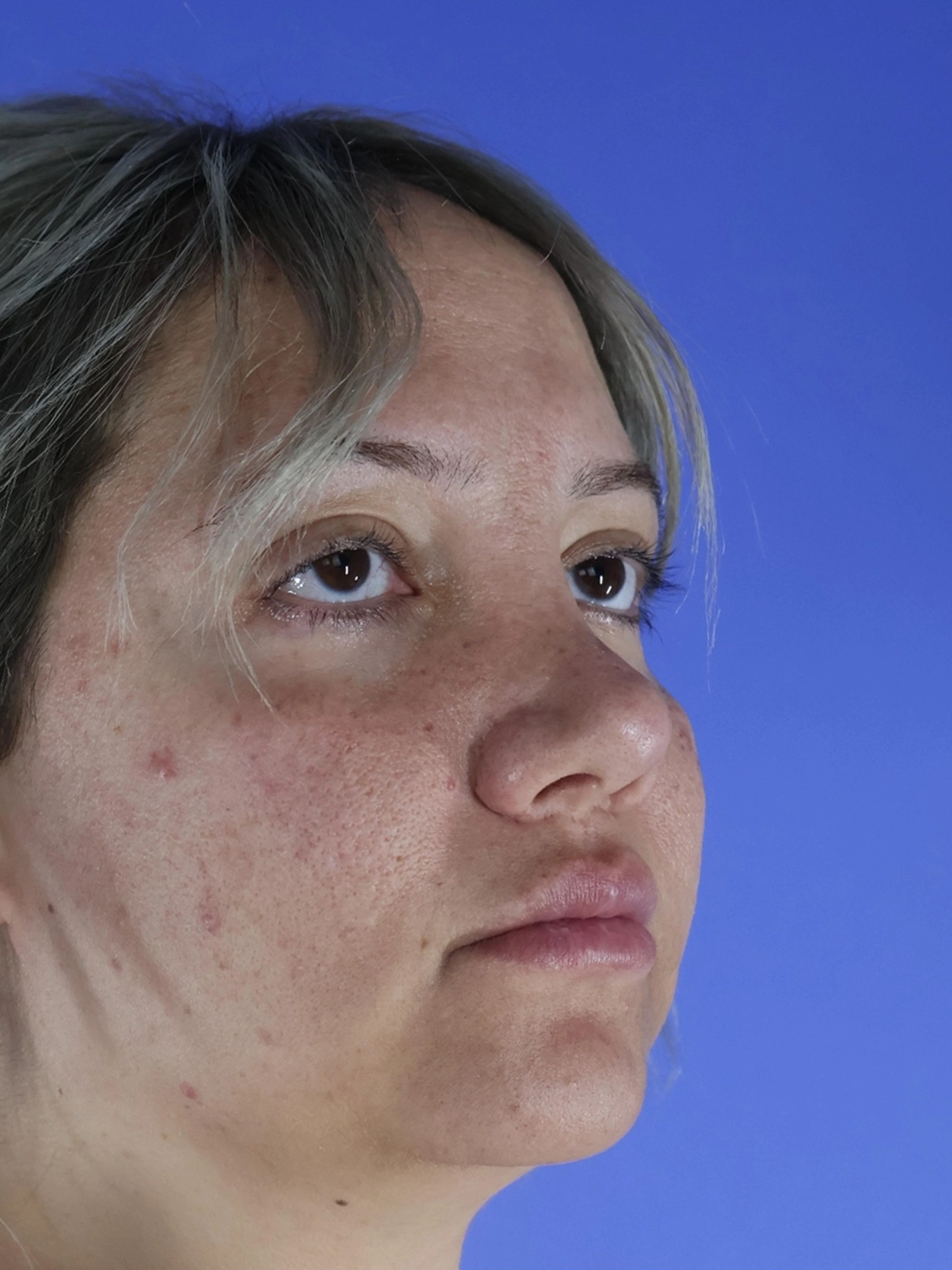 Rhinoplasty real patient case photo
